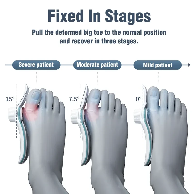 Adjustable Hallux Valgus Orthosis – 3-Board Bunion Corrector for Men & Women with Thumb Deformity Support